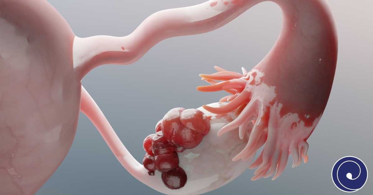 Aspiracija ciste jajnika