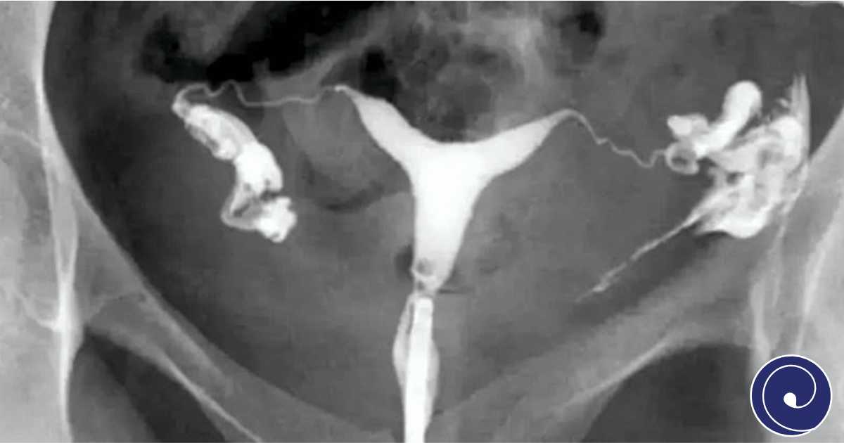 HSG (Histerosalpingografija)